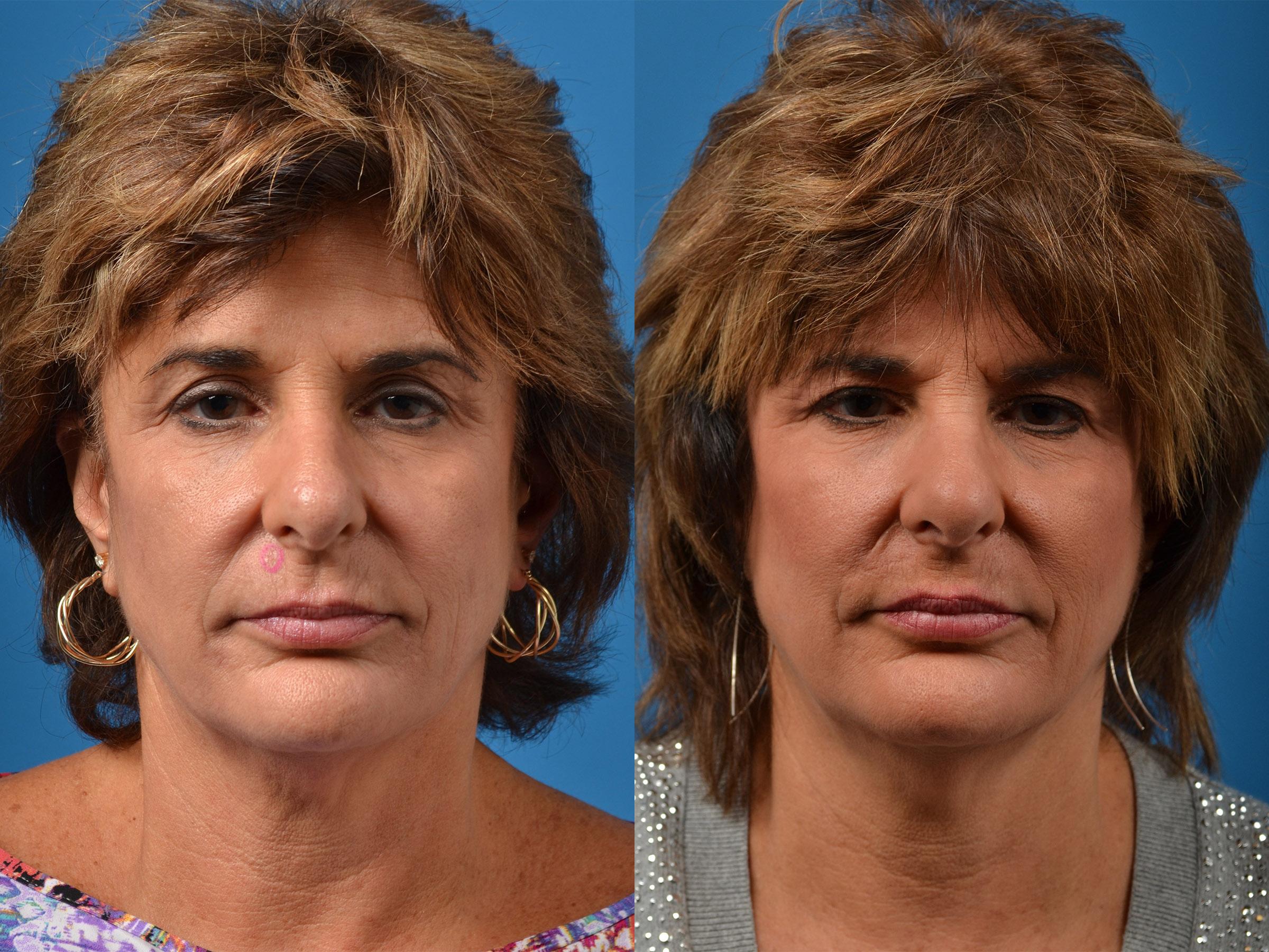 arcadia-mohs-before-and-after-photos-pasadena-plastic-surgery-photo